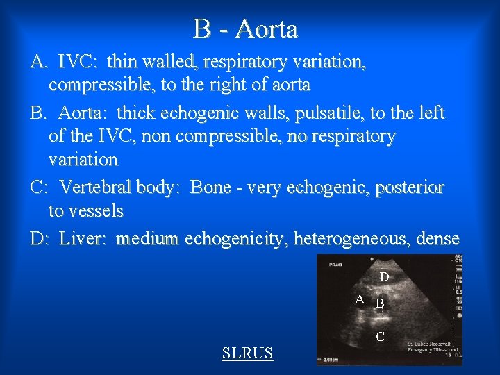 B - Aorta A. IVC: thin walled, respiratory variation, compressible, to the right of