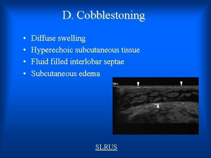 D. Cobblestoning • • Diffuse swelling Hyperechoic subcutaneous tissue Fluid filled interlobar septae Subcutaneous