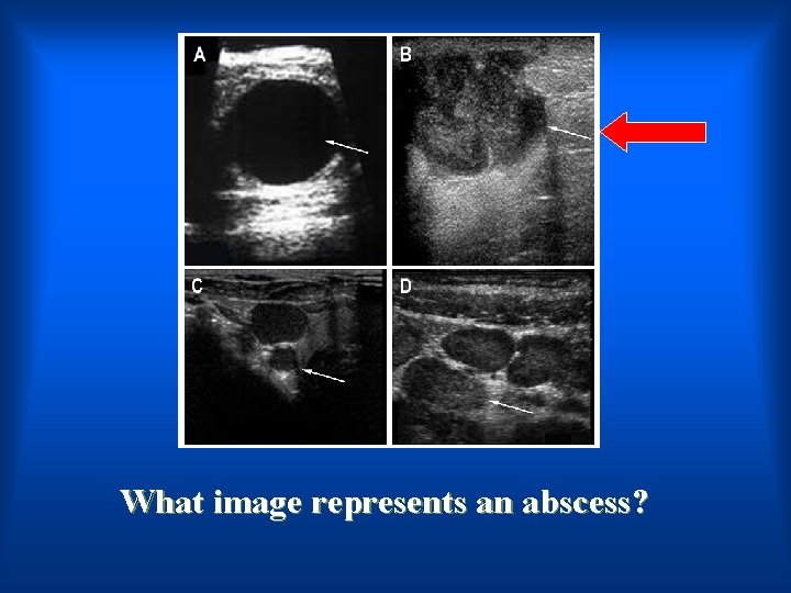 What image represents an abscess? 