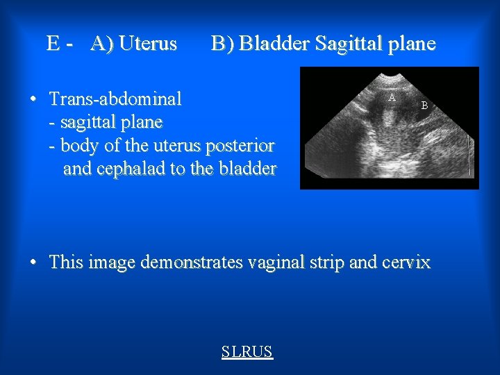 E - A) Uterus B) Bladder Sagittal plane • Trans-abdominal - sagittal plane -