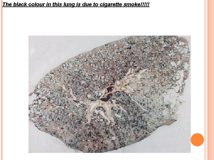 The black colour in this lung is due to cigarette smoke!!!!! 
