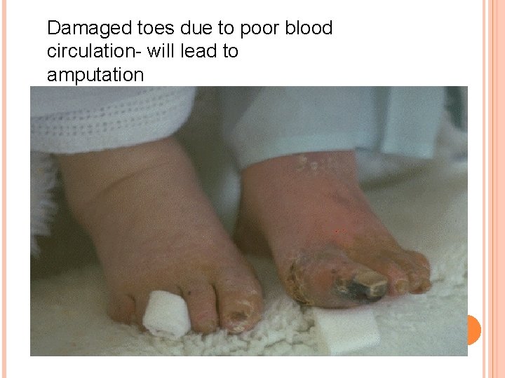 Damaged toes due to poor blood circulation- will lead to amputation 