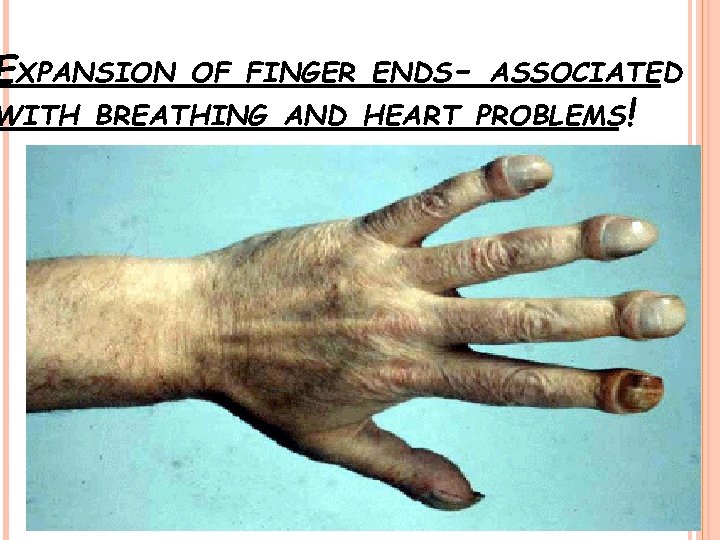 EXPANSION OF FINGER ENDS- ASSOCIATED WITH BREATHING AND HEART PROBLEMS! 