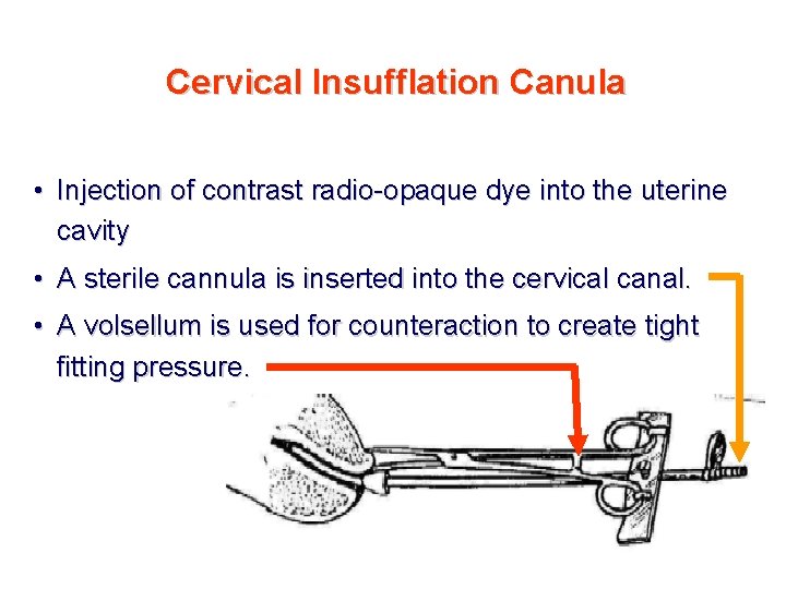 Cervical Insufflation Canula • Injection of contrast radio-opaque dye into the uterine cavity •