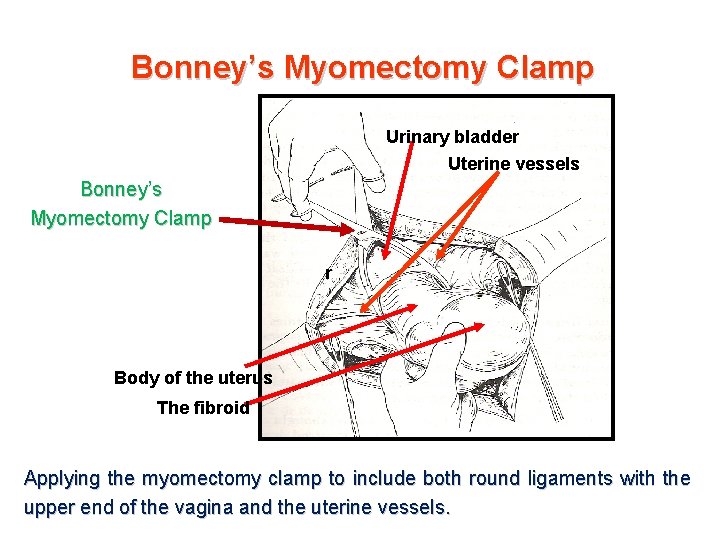 Bonney’s Myomectomy Clamp Urinary bladder Uterine vessels Bonney’s Myomectomy Clamp r Body of the