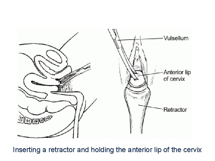 Inserting a retractor and holding the anterior lip of the cervix 