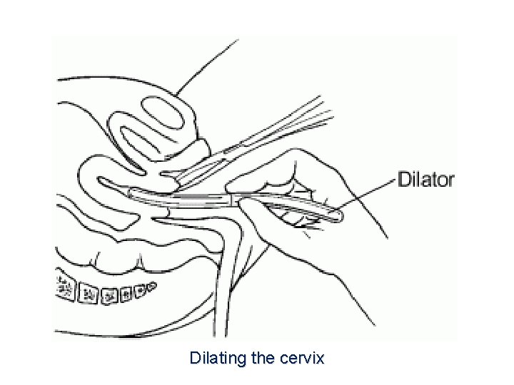Dilating the cervix 