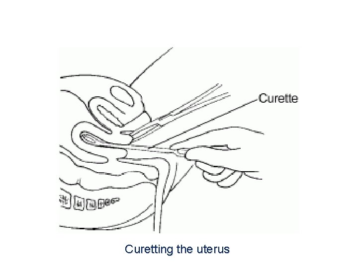 Curetting the uterus 