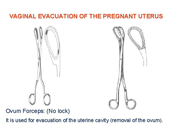 VAGINAL EVACUATION OF THE PREGNANT UTERUS Ovum Forceps: (No lock) It is used for