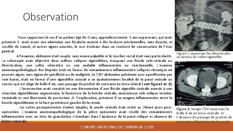 Observation Nous rapportons le cas d’un patient âgé de 41 ans, appendicectomisé 5 ans