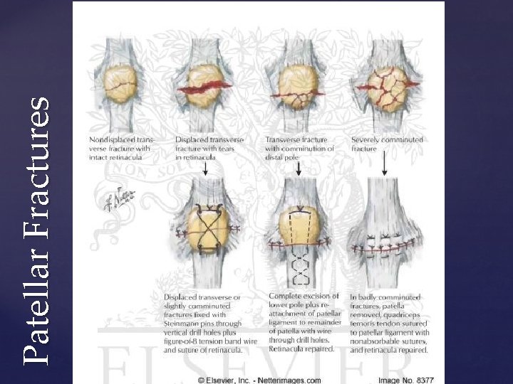 Patellar Fractures 