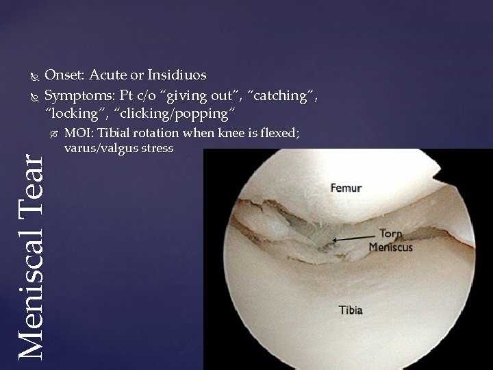  Onset: Acute or Insidiuos Symptoms: Pt c/o “giving out”, “catching”, “locking”, “clicking/popping” Meniscal