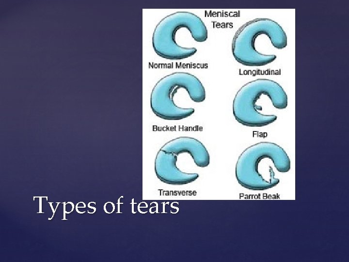Types of tears 