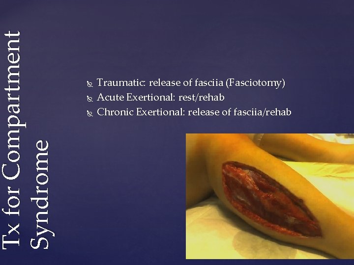 Tx for Compartment Syndrome Traumatic: release of fasciia (Fasciotomy) Acute Exertional: rest/rehab Chronic Exertional: