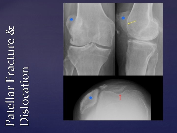 Patellar Fracture & Dislocation 