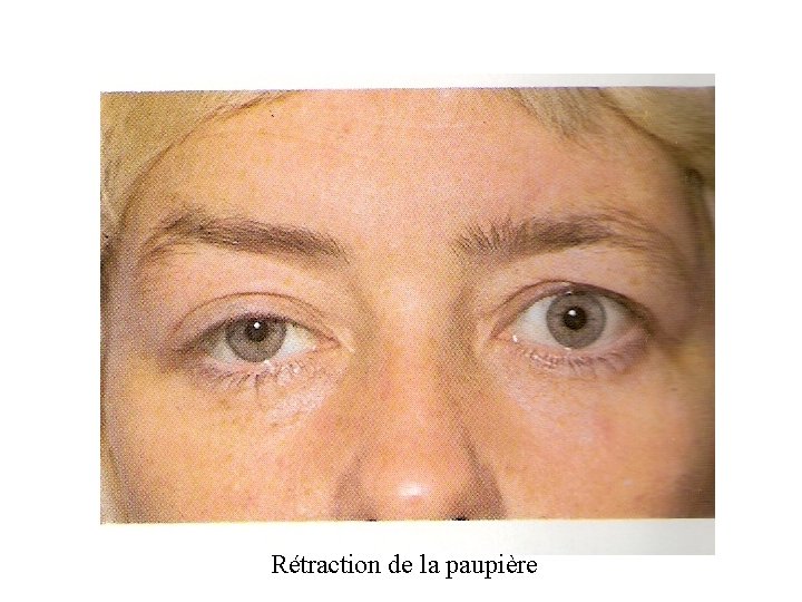 Rétraction de la paupière 