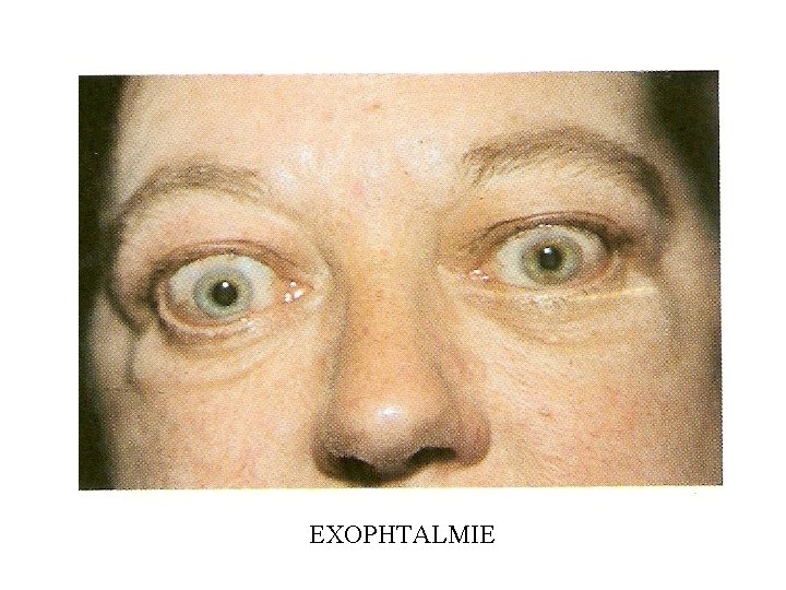 EXOPHTALMIE 