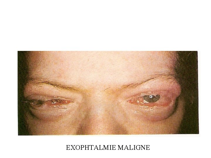 EXOPHTALMIE MALIGNE 