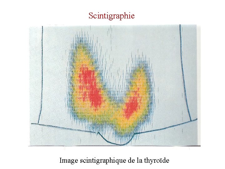 Scintigraphie Image scintigraphique de la thyroïde 