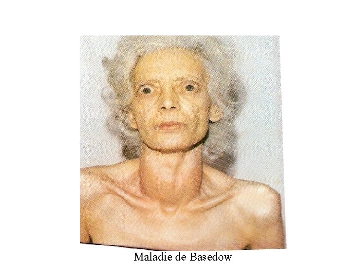 Maladie de Basedow 
