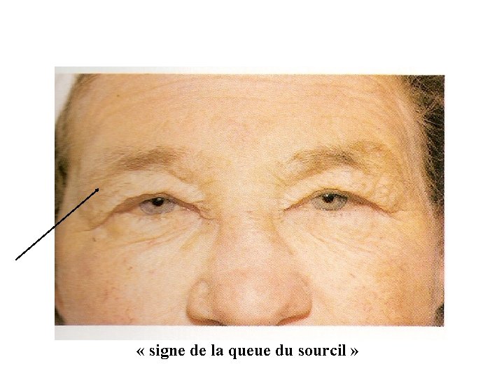  « signe de la queue du sourcil » 