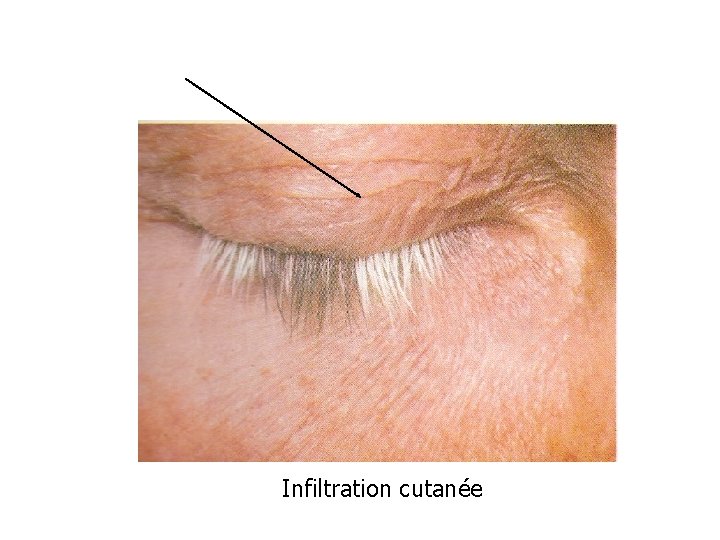 Infiltration cutanée 