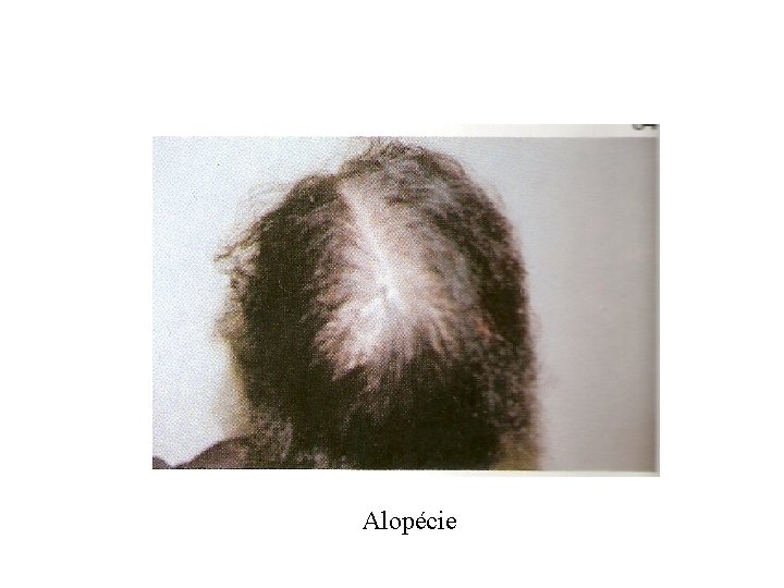 Alopécie 