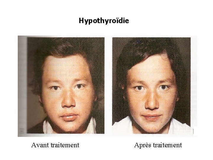 Hypothyroïdie Avant traitement Après traitement 