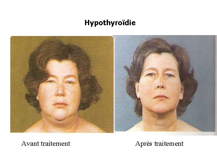 Hypothyroïdie Avant traitement Après traitement 