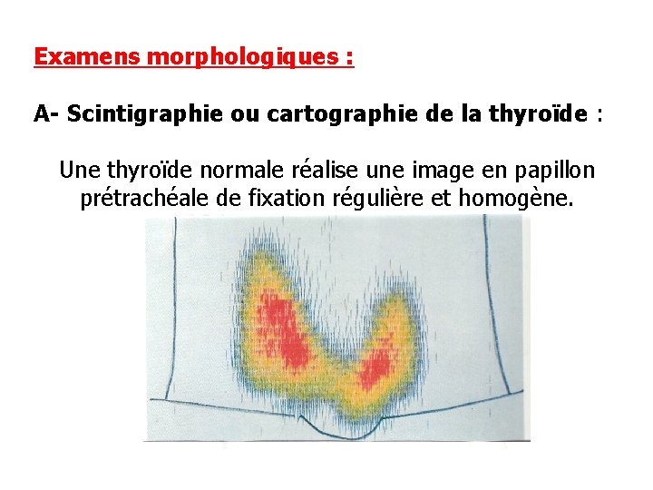 Examens morphologiques : A- Scintigraphie ou cartographie de la thyroïde : Une thyroïde normale
