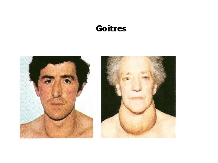 Goitres 
