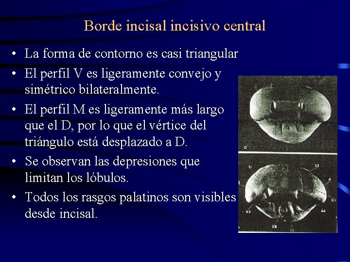 Borde incisal incisivo central • La forma de contorno es casi triangular • El