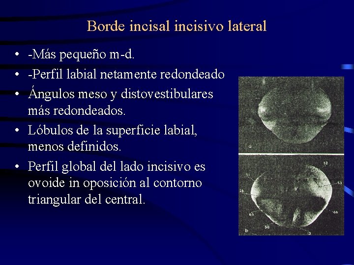 Borde incisal incisivo lateral • -Más pequeño m-d. • -Perfil labial netamente redondeado •