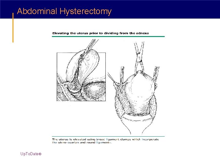 Abdominal Hysterectomy Up. To. Date® 