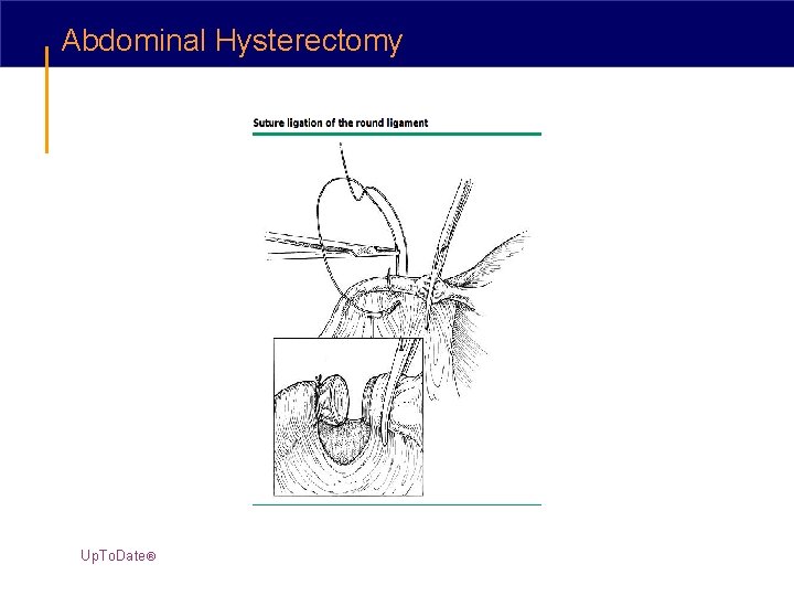 Abdominal Hysterectomy Up. To. Date® 