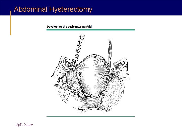 Abdominal Hysterectomy Up. To. Date® 