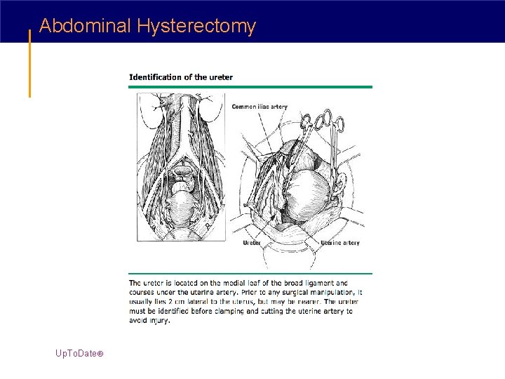 Abdominal Hysterectomy Up. To. Date® 