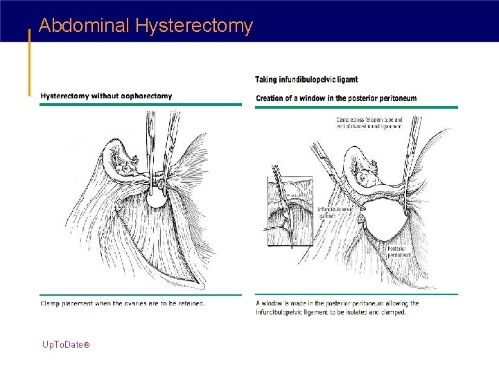 Abdominal Hysterectomy Up. To. Date® 