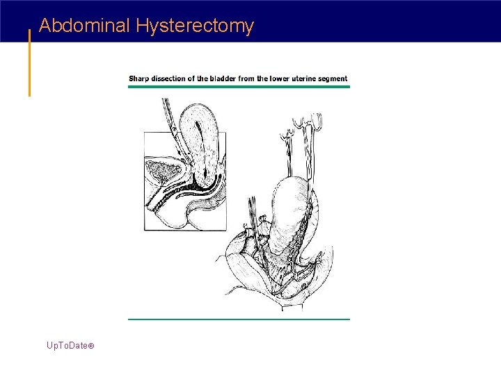 Abdominal Hysterectomy Up. To. Date® 