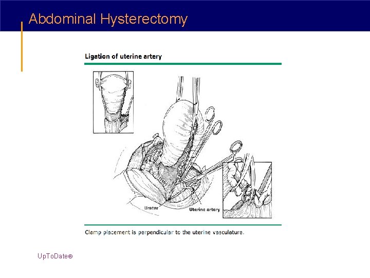 Abdominal Hysterectomy Up. To. Date® 
