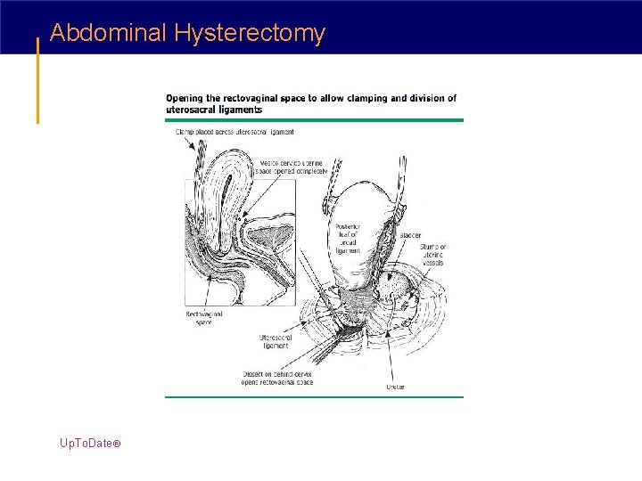 Abdominal Hysterectomy Up. To. Date® 