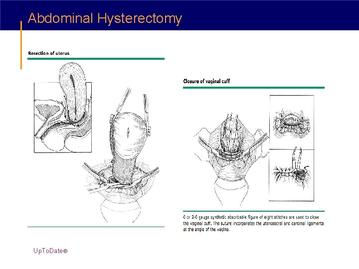 Abdominal Hysterectomy Up. To. Date® 