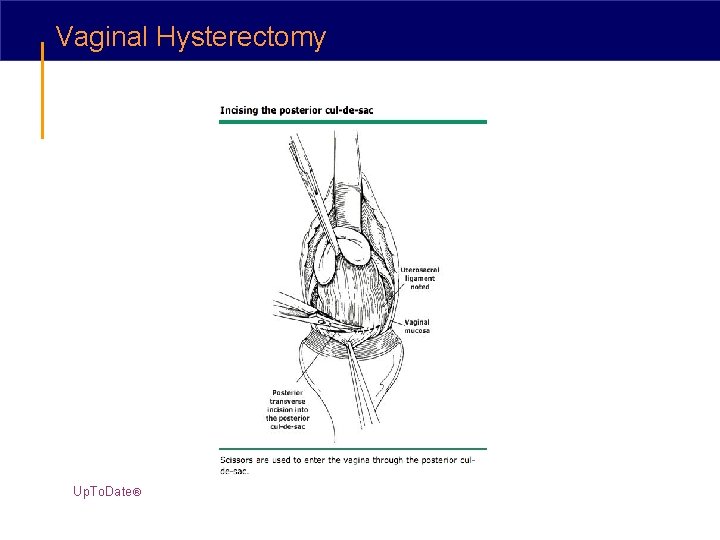 Vaginal Hysterectomy Up. To. Date® 