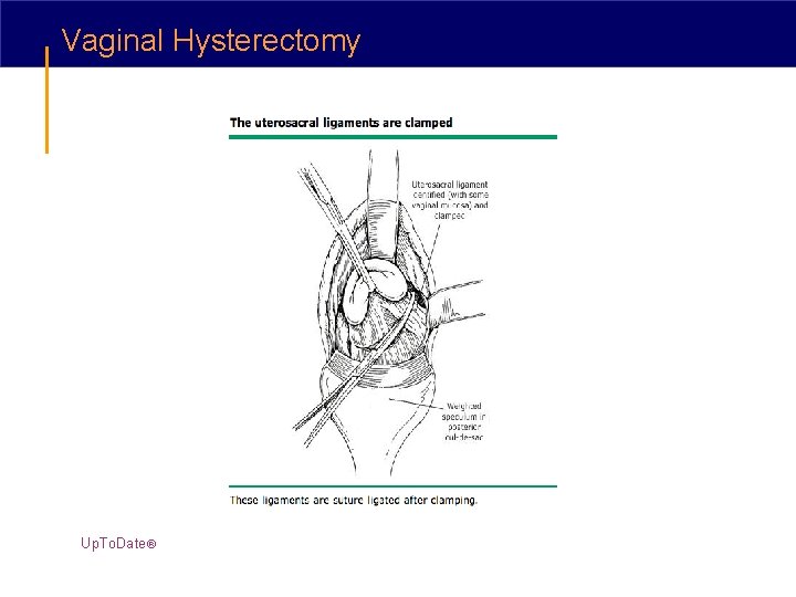 Vaginal Hysterectomy Up. To. Date® 