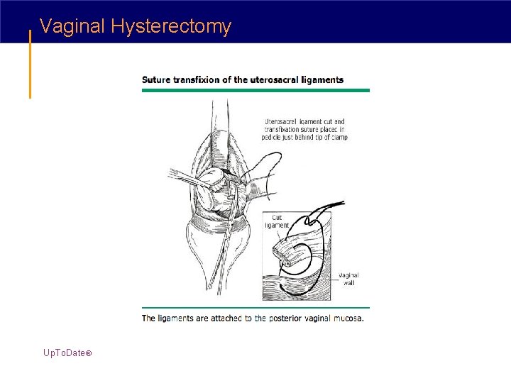 Vaginal Hysterectomy Up. To. Date® 