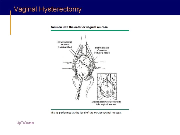 Vaginal Hysterectomy Up. To. Date® 