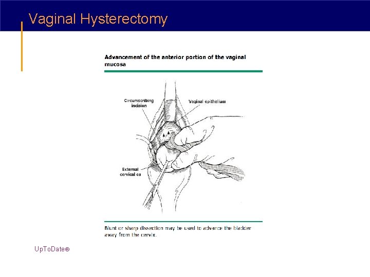Vaginal Hysterectomy Up. To. Date® 