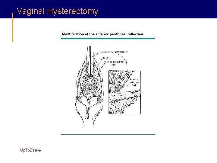 Vaginal Hysterectomy Up. To. Date® 