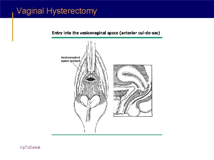 Vaginal Hysterectomy Up. To. Date® 