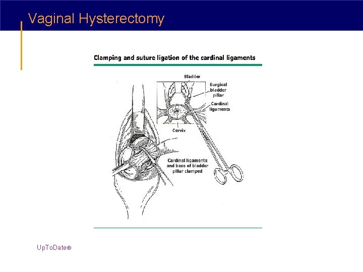 Vaginal Hysterectomy Up. To. Date® 